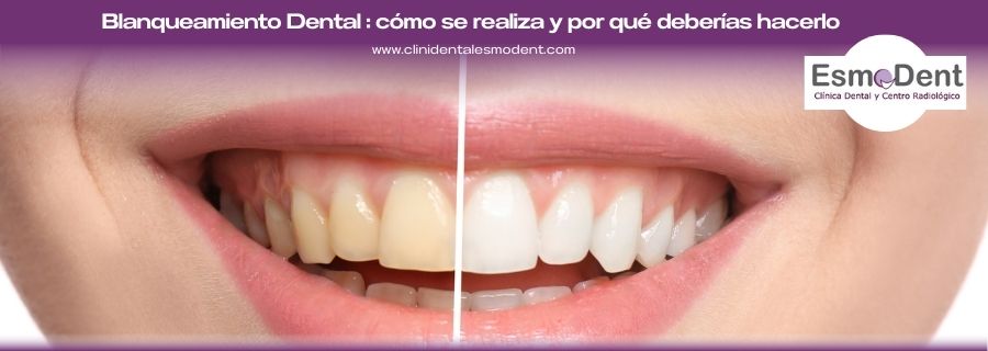 Blanqueamiento dental Picassent